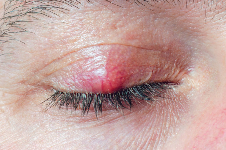 Stye and Chalazion Treatment in River Falls, WI | River Falls Eye ...