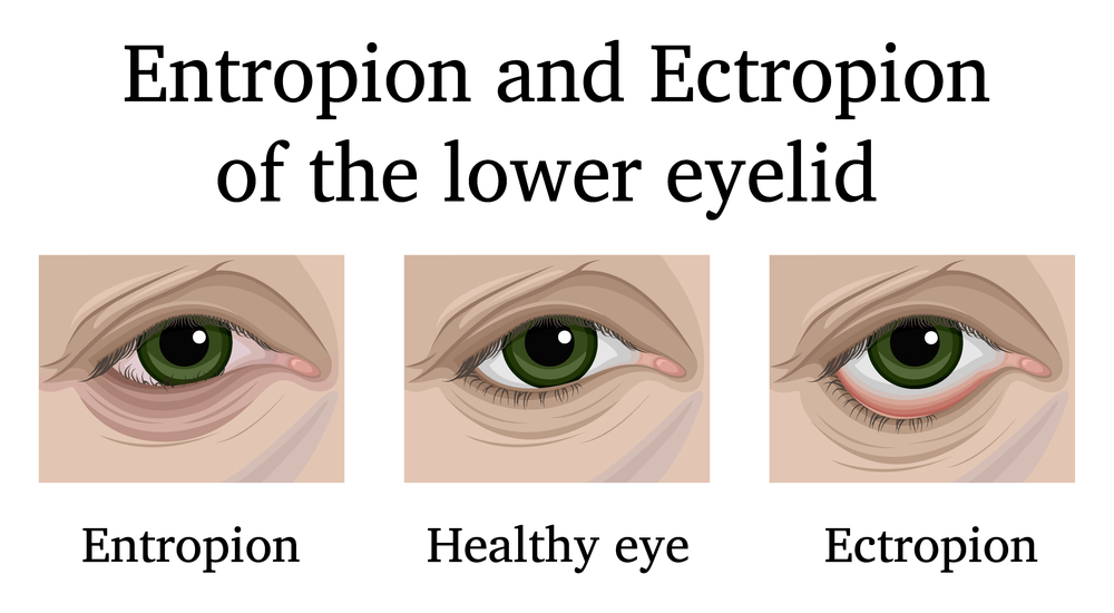 Entropion and Ectropion of Lower Eyelid